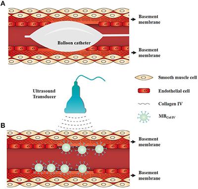 Molecular Ultrasound Monitoring of Early Artery Injury After Carotid Balloon Angioplasty